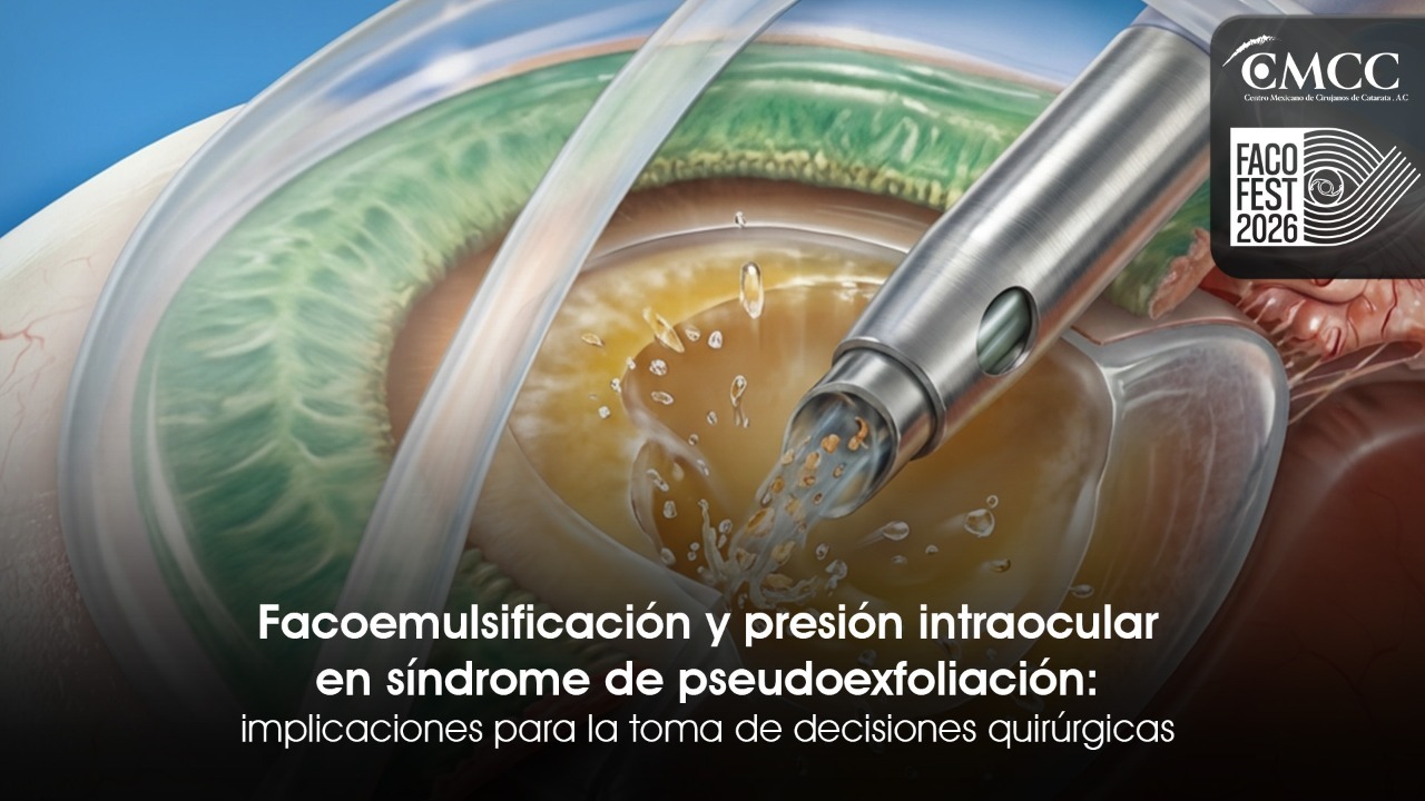 Facoemulsificación y presión intraocular en síndrome de pseudoexfoliación:  implicaciones para la toma de decisiones quirúrgicas