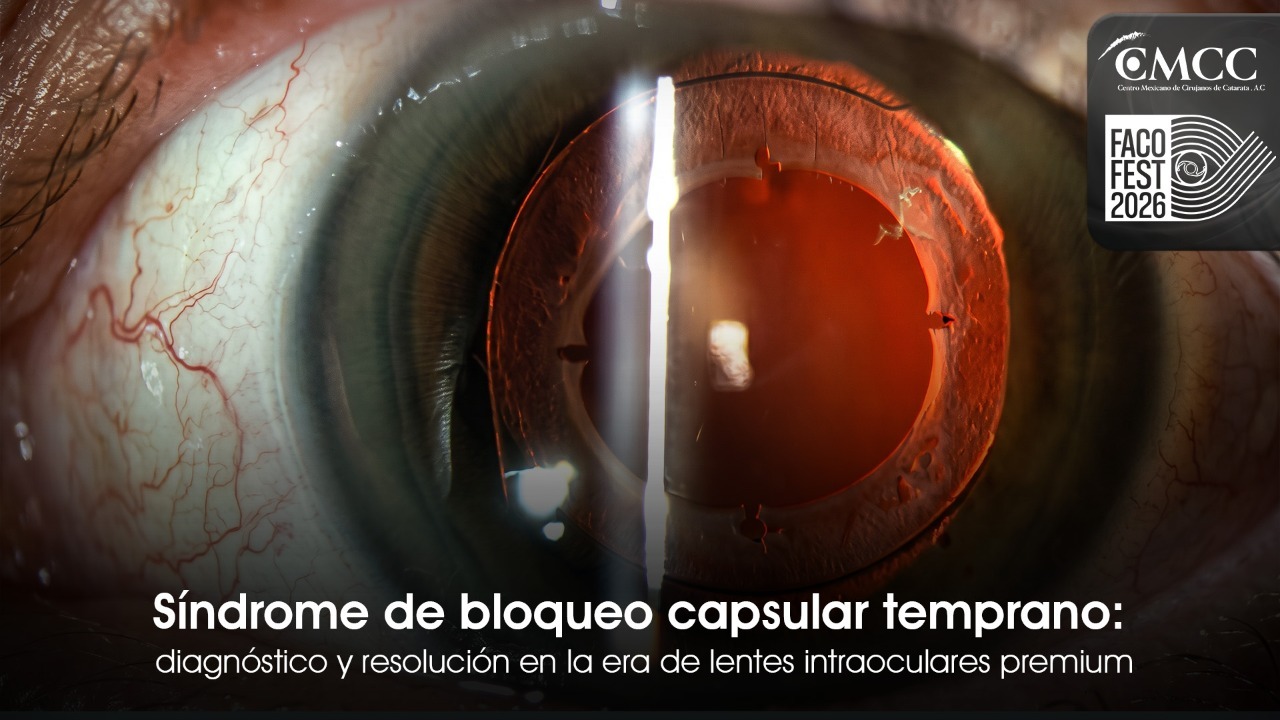 Síndrome de bloqueo capsular temprano: diagnóstico y resolución en la era de lentes intraoculares premium.
