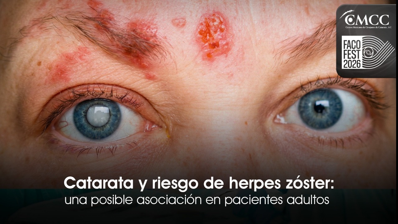Catarata y riesgo de herpes zóster: una posible asociación en pacientes adultos.